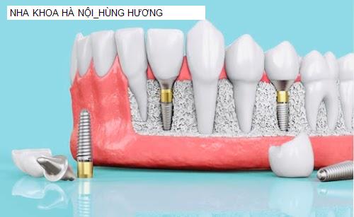 Hình ảnh NHA KHOA HÀ NỘI_HÙNG HƯƠNG
