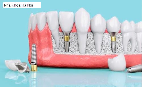 Hình ảnh Nha Khoa Hà Nội